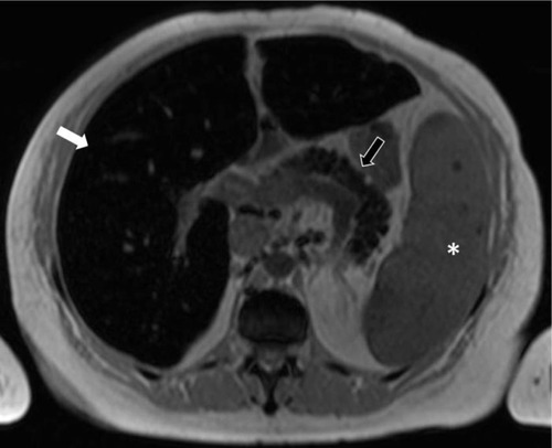 Figure 15 MRI showing iron overload in the liver and pancreas.