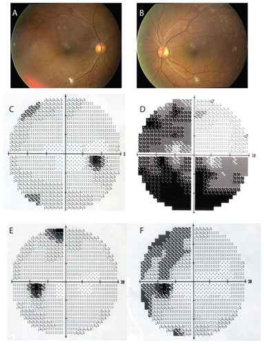 Figure 2 Fundus photograph and results of Humphrey static perimetry. (A and B) At the onset, fundus photograph showed that the retina and disc were normal. (C and D) At the onset, Humphrey static perimetry showed inferior temporal field defect in the left eye (30-2 strategy MD –17.57 dB), and normal field in the right eye. (E) One year after the onset, Humphrey static perimetry showed the visual field was almost normal (30-2 strategy MD –2.35 dB). (F) One month after surgery, Humphrey static perimetry showed a mild temporal hemianopia (30-2 strategy MD –3.19 dB).