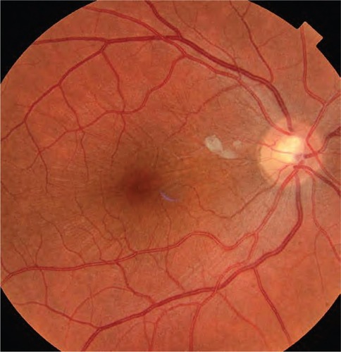 Figure 6 Fundus photograph of the right eye taken more than 1 year after the patient’s initial presentation.