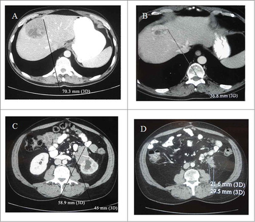 Figure 1. CT scan of the abdomen performed before the start of epirubicin plus dacarbazine treatment and 6 months later. The hepatic and adenopathic lesions regressed from 70.3 mm (A) to 36.8 mm (B) and from 58.9 × 45 mm (C) to 21.6 × 29.5 mm respectively (D).