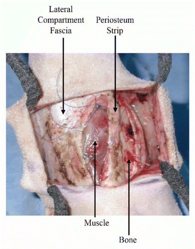 Figure 5 A complex wound involving injury to muscle, fascia, periosteum and bone.Citation126