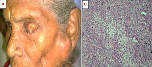 Figure 1 (A) Clinical photograph of a 80-year-old female patient with a left upper eyelid nodulo-ulcerated sebaceous gland carcinoma with preauricular lymph node metastasis. (B) Microphotograph of a moderately differentiated sebaceous gland carcinoma showing lobules of malignant cells with sebaceous differentiation.