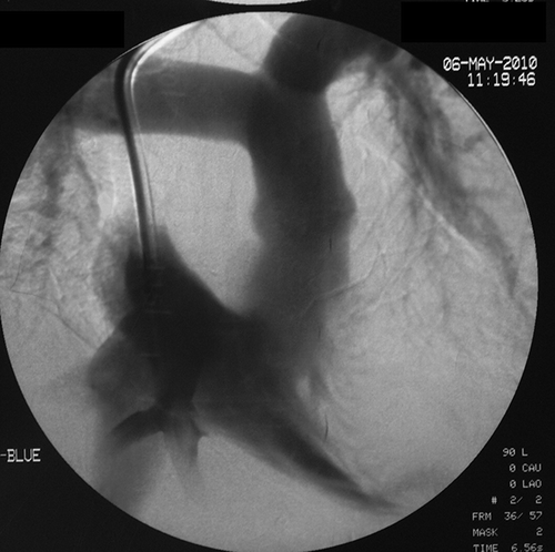 Figure 1. Angiography of first case: hemodialysis catheter’s tip positioning into the hepatic veins.