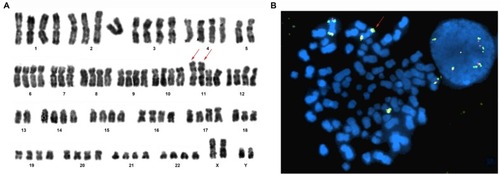 Figure 3 Karyotype and FISH analysis (Case 9).Notes: Numbers 1 -22 represent chromosomes. (A) Karyotype (R-banding): 86, XXYY, −5, –5, –7, I (11q)×2, –13, −13, –18. Red arrow represents isodicentric 11q chromosomes. (B) FISH analysis with GLP MLL dual color break-apart probe (located at 11q23). The probe confirms two idic (11q) chromosomes (red arrow). Magnification ×1000.Abbreviation: FISH, fluorescence in situ hybridization.