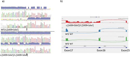 Figure 3. DNA and RNA sequencing results. A) Electropherogram from genomic DNA sequence in parent II-1 (top) and proband III-1 (bottom). Arrow indicates heterozygote position in parent, and deletion in proband. B) Sashimi-plot from transcriptome sequencing showing region Exon15 to exon 17 in SCLT1-gene. Top trace in red represents proband III-1, and traces in blue and green, are normal controls with wild-type genotype.