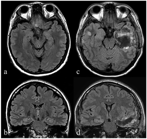 Figure 1. Anatomical imaging. The preoperative axial (a) and coronal (b) fluid-attenuated inversion recovery (FLAIR) MRI images demonstrate no hippocampal sclerosis. Post-operative axial (c) and coronal (d) FLAIR MRI images showing left-sided hippocampectomy including the amygdala and partial lateral temporal lobe.