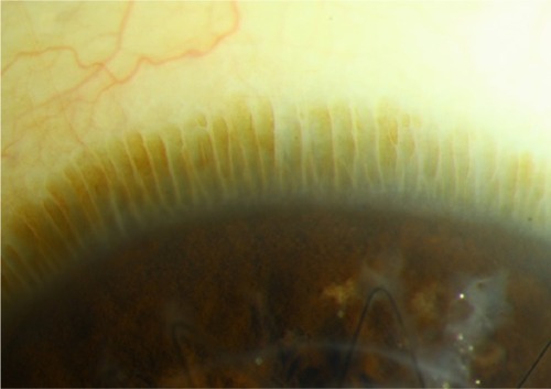 Figure 1 Slit-lamp photograph of the palisades of Vogt at the limbus of an eye with a healthy ocular surface.
