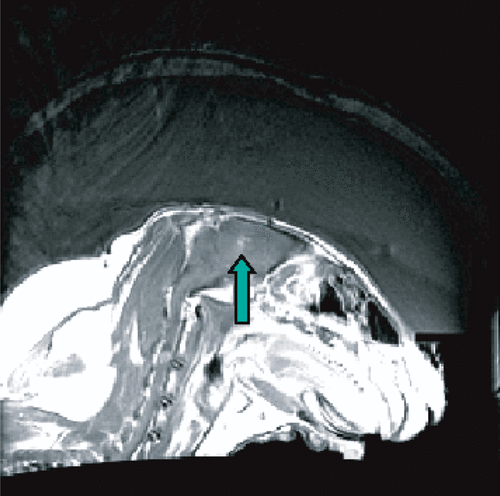 Figure 5. Bubble-enhanced tissue destruction as seen with MRI contrast enhanced imaging after the sonication. The image shows ultrasound being delivered through an ex vivo human calvarium and brain-mimicking phantom and into a rabbit brain in vivo.