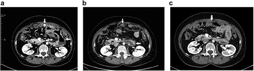 Figure 2. CT-scans in January 2018 (A) in October 2018 (B) and in February 2019 (C), showing a tumor reduction (reaching criteria for partial response according to RECIST) and the resolution of the pathological intestinal dilation (white arrows) .