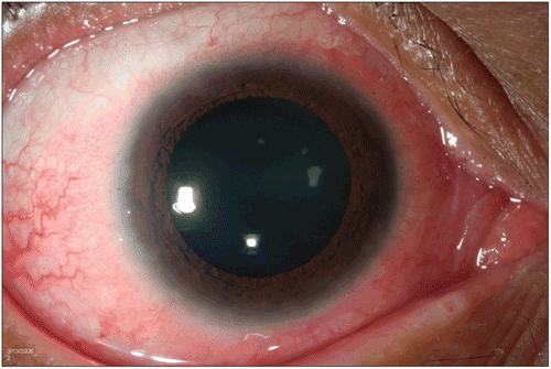 FIGURE 1  Case 1 prior to treatment with intravenous daclizumab demonstrates 2+ diffuse scleral injection following topical phenylephrine.