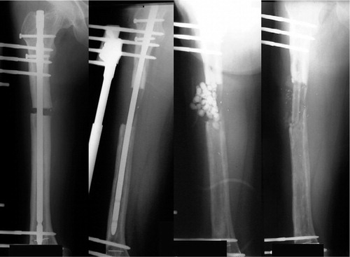 Figure 1 (case 17). The patient underwent of femoral lengthening over an intramedullary nail. 2 months after the operation, the quality of the callus was poor. At 3 months, a purulent infection occurred from the pin site and distracted area. Antibiotic cement beads were inserted. A vascularized fibular graft was then inserted and the infection and the bone defect healed.