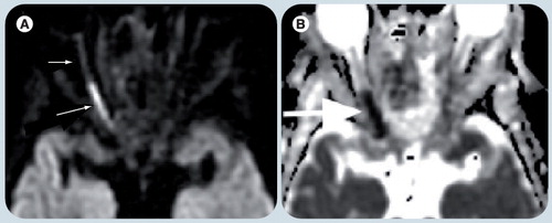 Figure 5. A case of rhinocerebral mucormycosis with acute right optic nerve infarction.(A) Diffusion-weighted imaging and (B) apparent diffusion coefficient map shows marked restricted diffusion (arrow) in the posterior portion of the right optic nerve when compared with the normal anterior aspect (arrowhead) of the nerve.Reprinted with permission from Citation[18].