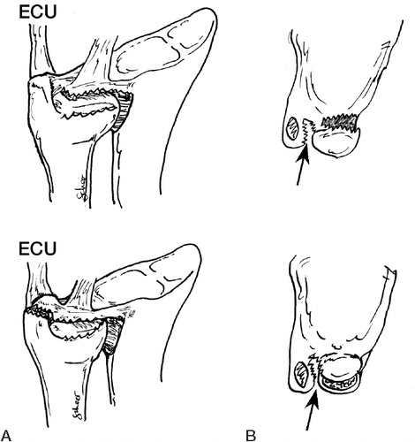 Figure 5. Type-2 foveal TFCC fibre disruption. A. Oblique palmar view. Complete disruption of the palmar capsule with either a sagittal rupture of the superficial fibers of the radio­ulnar ligaments (upper panel) or an ulnar styloid fracture of type 1 (lower panel). B. Transverse view. Arrow: the dorsal separation between the ECU tendon sheath and the TFCC.