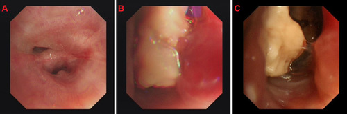 Figure 2 (A) The opening of the left lower lobe is narrow. (B and C) There is a big and white neoplasm in the lower left lung, with a lot of white necrotic material in the subsegment.
