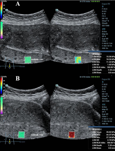 Figure 2 Anterior myometrial SWE image from a pregnant female with gestational diabetes mellitus, age 29. (A) Anterior myometrial SWE (15.36 kPa). (B) Posterior myometrial SWE (35.02 kPa).