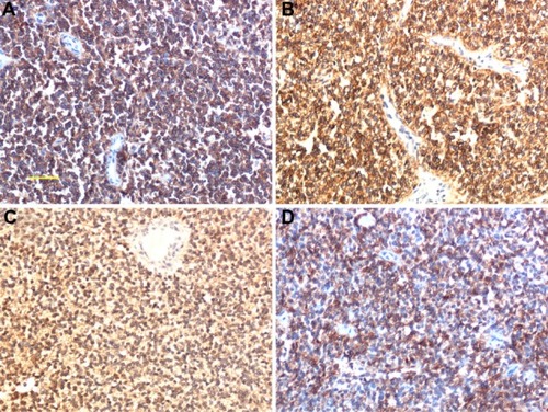 Figure 3 Immunohistochemical findings. (A) Strong reactivity in tumor cells with anti-cluster of differentiation (CD) 99. (B) CD117; membranous and cytoplasmic staining. (C) Neuron-specific enolase, cytoplasmic staining (×200). (D) CD56; membranous staining.