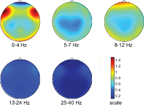 Figure 1. Topographical maps of EEG activity in in frequency ranges of interest in a patient sample with AD.