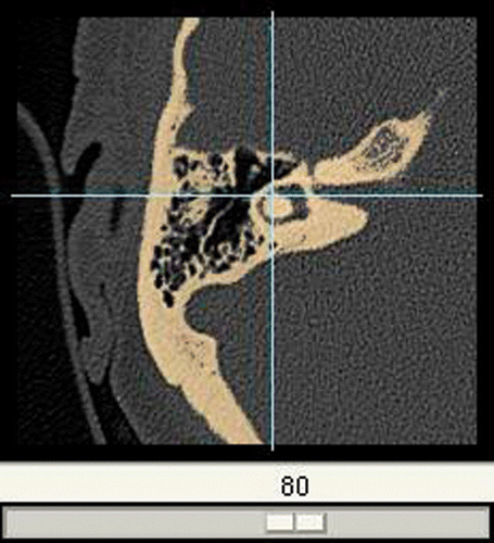 Figure 4. Threshold-based segmentation applied to the cropped image. The lateral semicircular duct is visible as a void in its bony surrounding.