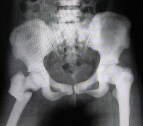 Figure 1 X-ray examination results of the pelvis showed a right subtrochanteric femoral fracture and osteosclerosis of the pelvis with bone-within-bone appearance in the iliac wing and obliteration of the femoral medullary canal.