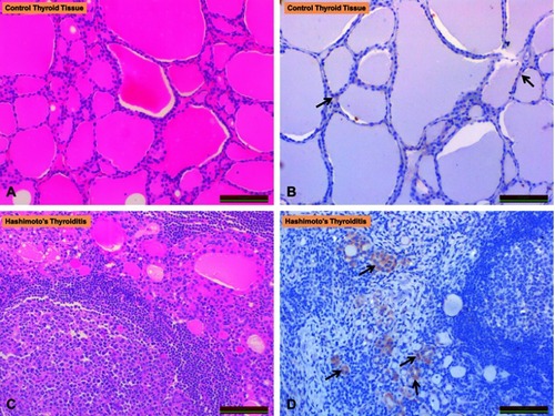 Figure 1 Comparison of irisin expression in hashimoto’s thyroiditis and thyroid tissues of controls. (A) Control thyroid tissues (H&E staining). (B) Control thyroid tissues (irisin staining). (C) Hashimoto’s thyroiditis (H&E staining). (D) Hashimoto’s thyroiditis (irisin staining). Arrows show irisin immunoreactivity (black arrows).