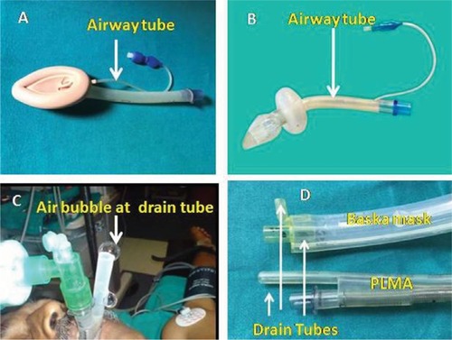 Figure 8 Airway and drain tubes and bite block of EADs: (A) airway tube – cLMA, (B) airway tube – Cobra PLA™, (C) drain tube – PLMA and (D) drain tube of Baska mask and PLMA.