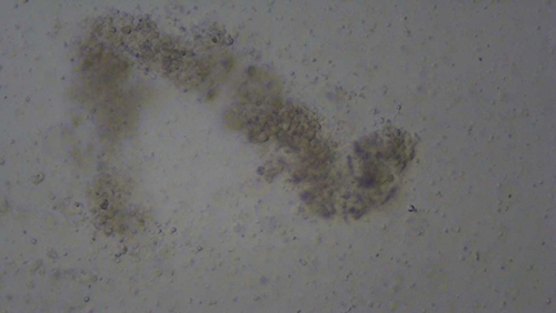 Figure 3 Aged white blood cell clusters in the shape of glandular tubes are visible in the prostatic fluid (magnified 500x under microscopy).