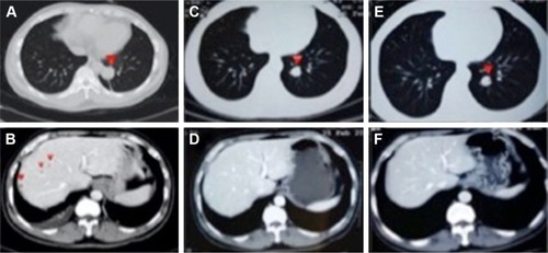 Figure 1 CT scan before and after apatinib/TMZ treatment (the lesions are indicated by red triangles): multiple metastases can be found in lungs and liver before apatinib/TMZ therapy (A and B), and the lesions were smaller in lungs (C and E) after 2 months’ administration of apatinib/TMZ and could barely be seen in liver (D and F) after 5 months of apatinib/TMZ treatment.