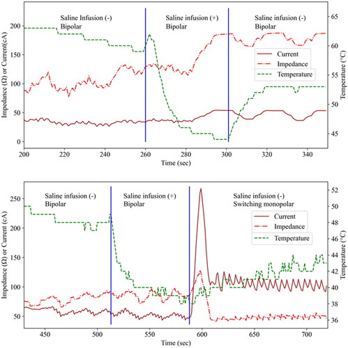 Figure 3. Changes in current, impedance, and temperature before, during, and after adjuvant saline infusion in two cases with adjuvant injection (AI).In both cases, the temperature (monitored by the MPN) dropped sharply at the beginning of the saline infusion. However, the saline infusion did not affect the impedance and current (monitored by the ICAEs) meaningfully in both cases.MPN: multipurpose needle; ICAE: internally cooled electrode with adjustable active tip length.