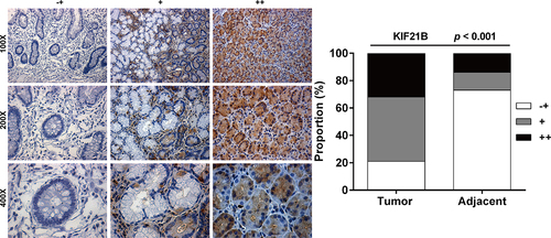 Figure 2. KIF21B protein level was highly expressed in GC tissues. Representative images of different degrees of KIF21B immunohistochemistry staining (-+, weak staining, + moderate staining, ++ strong staining) (left panel) and the percentage of KIF21B high in GC tissues was significantly higher than that in adjacent normal tissues (right panel).