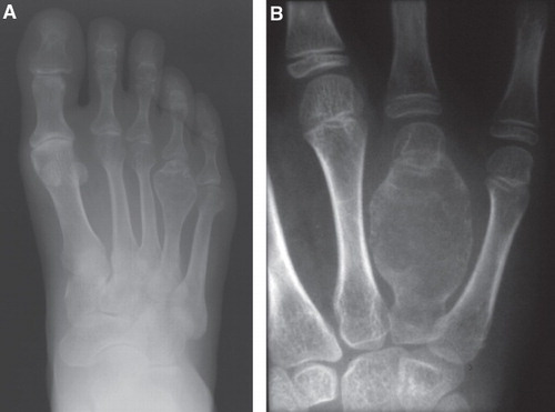 Figure 1. Radiograph of GCT involving the distal fourth metatarsal bone (A) and diaphysis of the fourth metacarpal bone (B). Both lesions are purely lytic with partially sclerotic rim and markedly expanded cortical bone, but with no cortical destruction. The centers of the lesions appear to be centrally located within the bones.