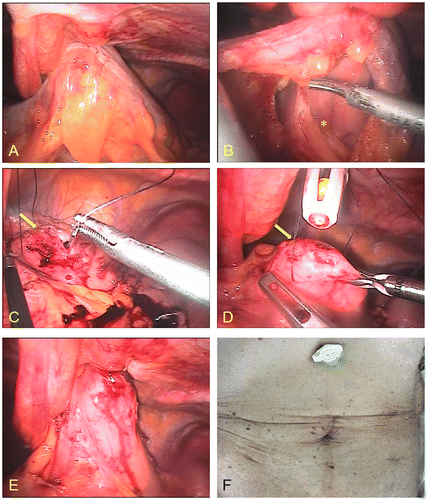 Figure 2. Intra-operative photographs (A–E). (A) The colon is lifted and fixed to the abdominal wall; a slight subserosal hemorrhage is visible. (B) The stomach is visible during removal of the transverse colon from the mesocolon; * indicates the stomach. (C) Suturing of the abdominal wall and the stomach via the same hole in the skin through which the PEG tube was inserted; arrows indicate the hole of the stomach. (D) A new tube was introduced into the stomach. (E) Image shows the anterior wall of the stomach fixed to the abdominal wall. (F) Image of the incisions a few days after surgery.
