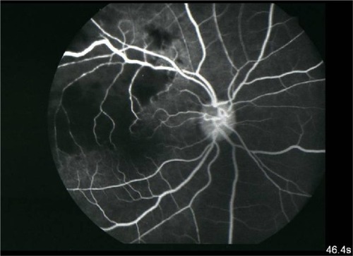 Figure 3 The retinal vein was dilated and tortuous.