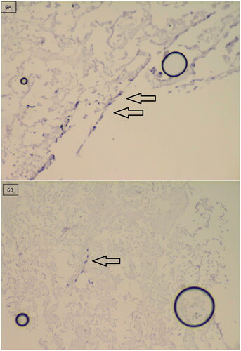 Figure 6. Hematoxylin-stained sections of iASC13EGFP cultured on top of human adipose tissue-derived ECM hydrogels after 6 days. Note that cells (visible by their dark blue nuclei) have migrated into the gel (arrows) at the periphery (A) and to the centre (B). iASC13EGFP: immortalized EGFP-tagged adipose derived stromal cells; ECM: extracellular matrix.