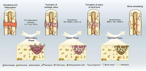 Figure 1 There are four stages of bone repair: hematoma and inflammation, cartilage callus formation, hard bone callus formation, and bone remodeling. And proinflammatory cytokines, growth factors and chemokines involved in bone regeneration.