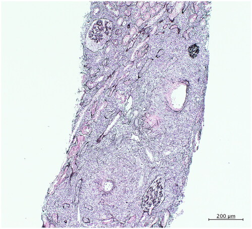 Figure 1. Representative image of renal biopsy. Severe tubulointerstitial damage with whole layer fibrinoid necrosis in the small arteries and tubulitis (200×, PAM).