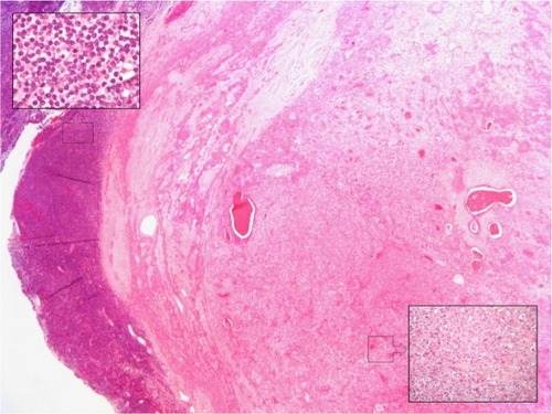 Figure 2 Pleomorphic adenoma with a malignant component of myoepithelial carcinoma (right inset).