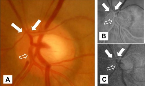 Figure 4 High magnification images of left fundus (A) and left fundus fluorescein angiography [(B) initial visit, (C) one month after the initial visit] at the optic disc.