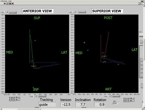 Figure 5. The computerized output showing the CAGI interface. In this screen view, the position of the reamer with respect to the glenoid face is shown. The left image represents an anterior view of the glenoid and the right image represents a superior view of the glenoid. The surgeon aligns the crossing axes, which represent the line of trajectory of the reamer, with the crossing axes of the target. (SUP = superior; INF = inferior, POST = posterior; ANT = anterior; MED = medial; LAT = lateral.) [Color version available online.]