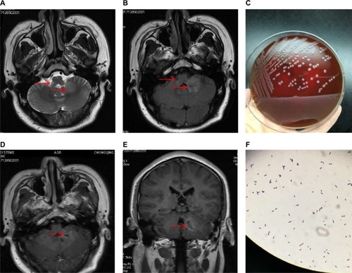 Figure 2 MRI findings and bacterial cultures when the patient’s condition worsened.Notes: Repeat MRI was performed and the lesions were found not only in the brainstem but also in the cerebellum with a hyper-intensity on (A) T2-weighted and (B) flair sequences (arrow). (C) Bacterial cultures were taken and Lm was identified. (D and E) The lesions were found patched or ring gadolinium-enhanced with abscess-like appearances (arrow). (F) Gram staining of the bacteria.Abbreviations: Lm, Listeria monocytogenes; MRI, magnetic resonance imaging.
