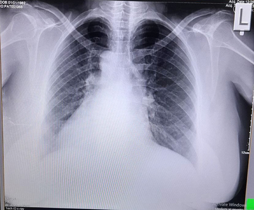 Figure 2 Posteroanterior Chest X ray.