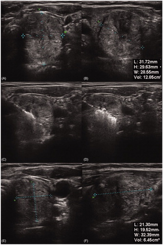Figure 4. Ultrasound images of a thyroid nodule before bipolar RFA (a and b), during ablation (c and d) and three months after ablation (e and f).