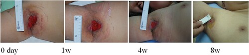 Figure 3. Zhang Wei, male, 55 years old, suffered from skin ulceration and infection after right axillary surgery. The infection was recurrent and uncured for more than 1 month. The healing rate was 95% after 8 weeks of ADSC treatment.