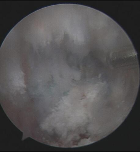 Figure 5 This arthroscopic view shows that loss of ACL graft on its femoral footprint, there was a suture left on the tunnel surface.