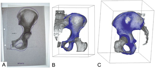 Figure 1.  A. An example of the template method. It consists of a comparison between a fluoroscopy and a manually drawn template from an anteroposterior radiography of the recipient. B and C. Example of registration method (3-D views). The user can rotate the 3-D view to examine bone congruency. 2-D slices can also be inspected.