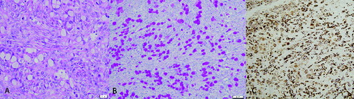 Figure 4. (A) Histopathology of the omentum. Neoplastic cells are present with severe desmoplasia. Hematoxylin and eosin. (B) Histochemical staining of the omentum. Neoplastic cells contain PAS positive material within the cytoplasm. PAS without diastase. (C) Immunohistochemistry of the omentum, goat; signet-ring carcinoma. Neoplastic cells are positive for cytokeratin (AE1/AE3) (200×).