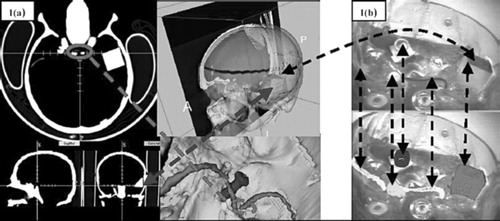 Figure 1. (a) Typical data displayed during neuronavigation, representing a virtual environment. (b) Three-dimensional geometry data (models) registered and displayed on a live video view. This represents an augmented-reality view. Note the difference between AR and VR. [Color version available online]