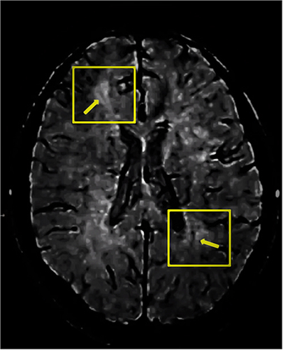 Figure 2 T2*-weighted gradient-echo MRI scan. Scan of a 19-year-old female patient from the ATC group who presented with seizures and was eventually diagnosed with CDMS with positive OCBs and CV-positive lesions in 57% of all lesions. Inside each of the yellow boxes lies a central vein positive lesion with the yellow arrows pointing to central vein.