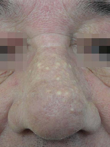 Figure 1. Mild–moderate rhinophyma with numerous cystic lesions before treatment.