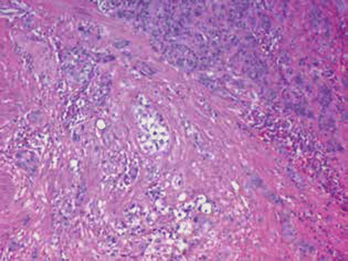Figure 1: Medium power magnification view of the histology of the tumor in case 1, showing cords of epithelioid cells in a hyalinised background invading deep into the myometrium. Some of the epithelioid cells display clear cytoplasm. Mitotic activity can also be seen. Haematoxylin and eosin, 100 × magnification.