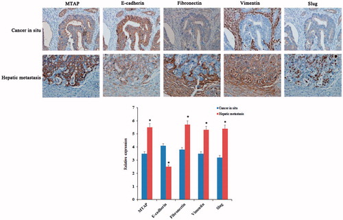 Figure 4. High expression of MTAP accelerated the liver metastasis of colorectal cancer. IHC examinations indicated increased expression levels of MTAP and the mesenchymal markers fibronectin, vimentin and slug and decreased expression of epithelial marker E-cadherin in the clinical liver metastasis specimens compared to the primary tumor (×200). *indicated p < .05.